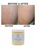 Strech Marks Cream